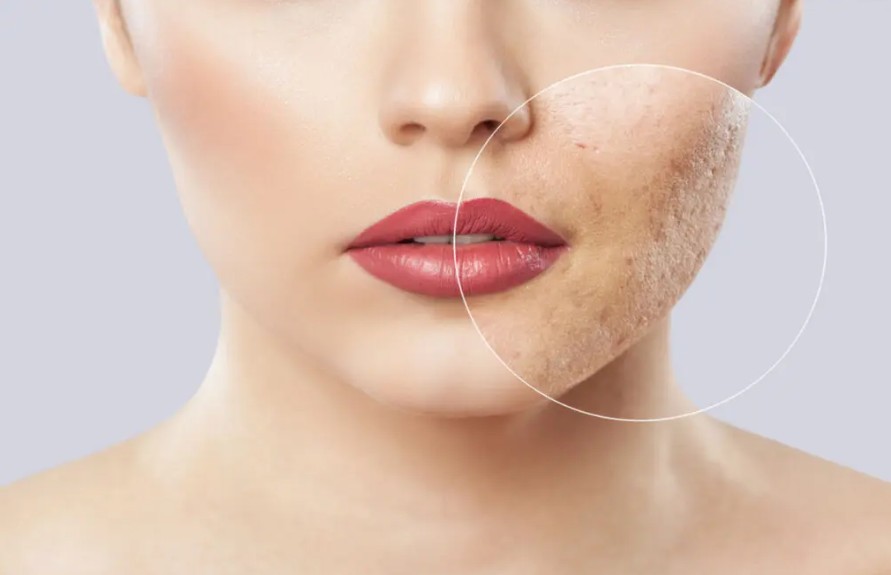 Acne Scar Treatment